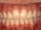 Overbite after